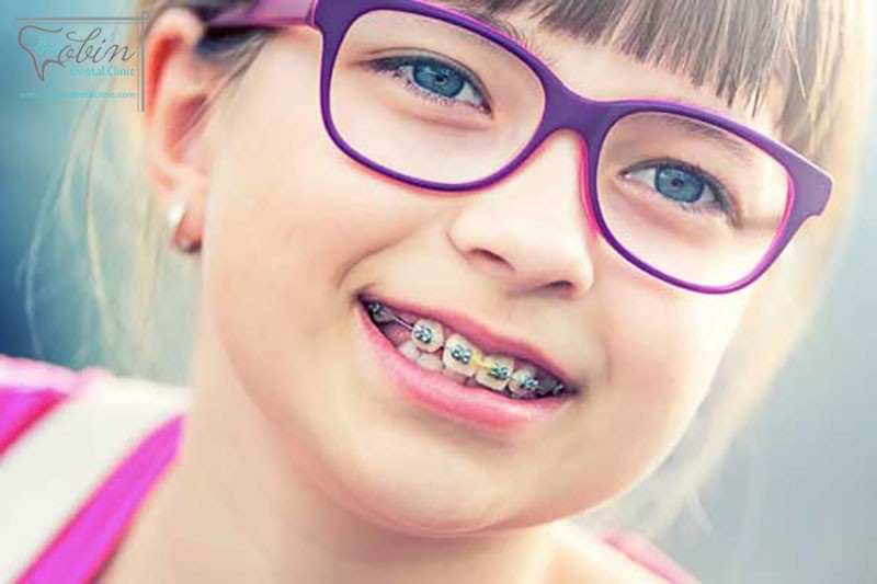 سوالات متداول ارتودنسی دندان و سن انجام آن